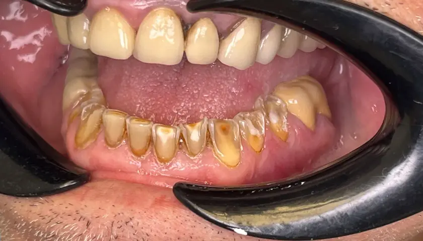 Boca abierta con dientes amarillentos y desgastados, mostrando signos de **abrasión dental**. Se aprecian restauraciones y encías inflamadas.