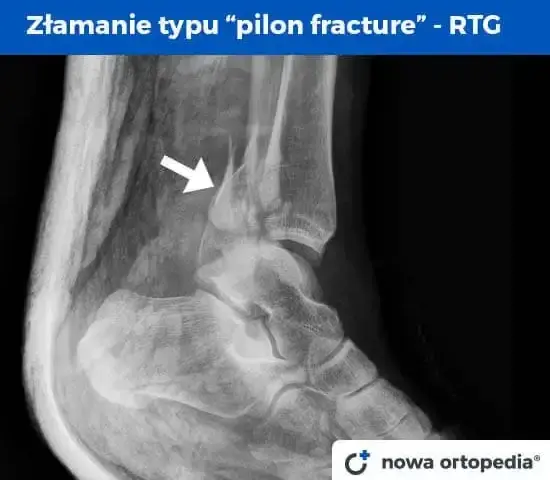 Złamana kostka boczna: Ile trwa leczenie i powrót do sprawności?