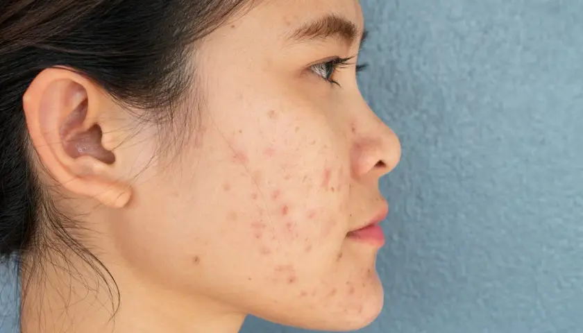 Profil d'une jeune femme avec une peau marquée par des rougeurs et des imperfections, évoquant une **cicatrice zona** ou de l'acné.