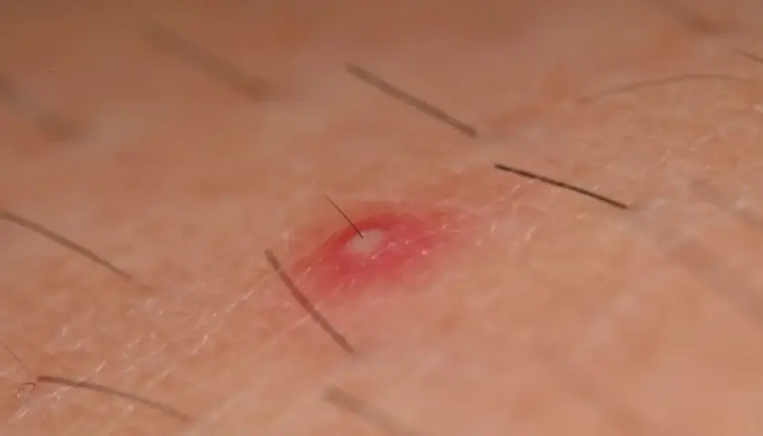 Czerwona, opuchnięta skóra z widocznym włoskiem, który wyrasta z małego, białego czubka. Wyleczyłam zapalenie mieszków włosowych.