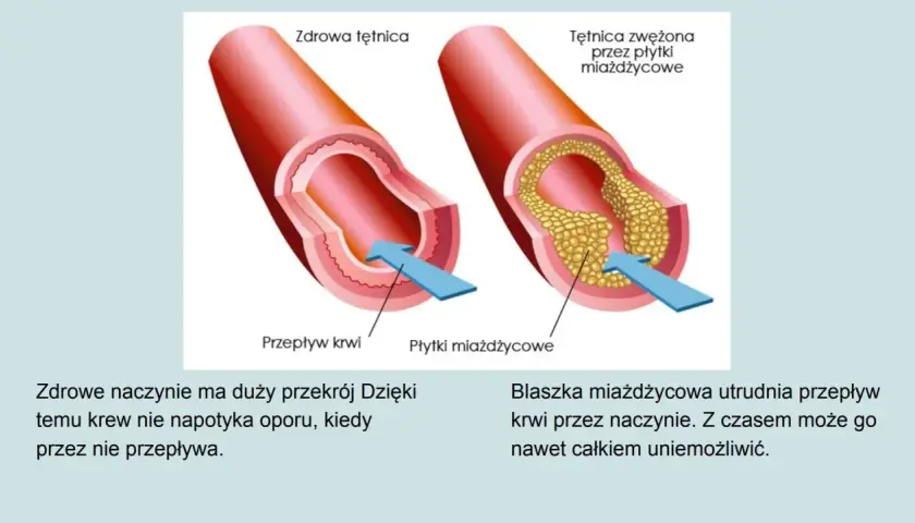 Porównanie zdrowej tętnicy z tą zwężoną przez płytki miażdżycowe. Układ krwionośny jest kluczowy dla zdrowia.