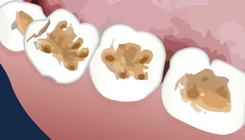 Dientes con cavidades marrones y oscuras, indicando caries en dentina.