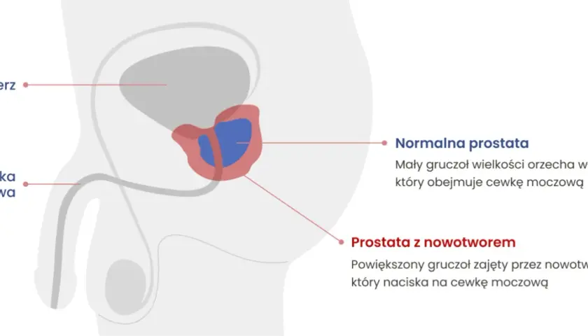 Choroba prostaty objawy - jak je rozpoznać i uniknąć powikłań