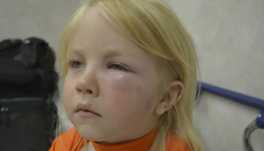 Silne uczulenie na komary u dziecka. Powieka jest mocno opuchnięta, zaczerwieniona, z widocznymi śladami ukąszeń na policzku.
