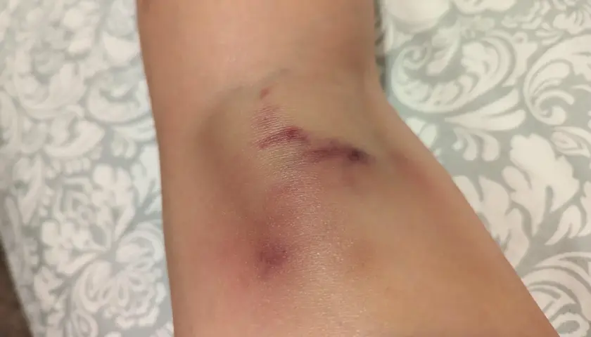 Widoczne siniaki na nodze, pamiątka po intensywnym treningu pole dance.