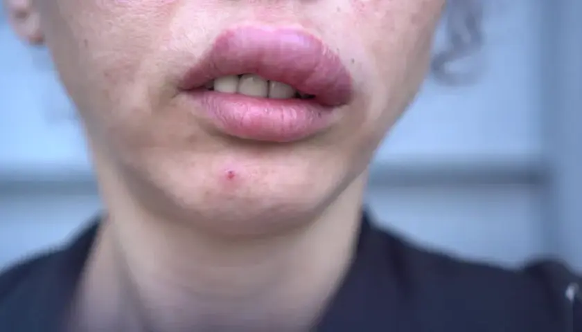 Alergia na sezam: 5 objawów które powinny cię zaniepokoić