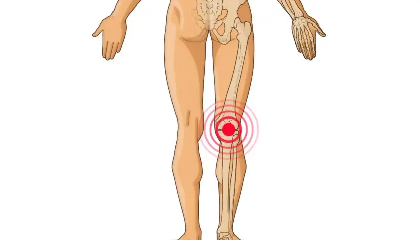 Röntgenbild des menschlichen Beins mit Fokus auf die Knieanatomie und Sehnen. Ein roter Kreis zeigt Schmerzen im Kniebereich an.