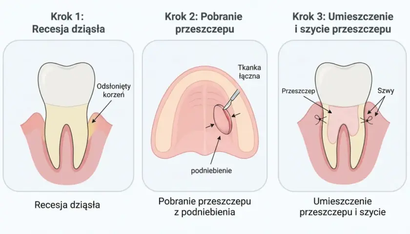 Ilustracja pokazuje etapy zabiegu: recesję dziąsła, pobranie tkanki z podniebienia i umieszczenie przeszczepu dziąsła z podniebienia.