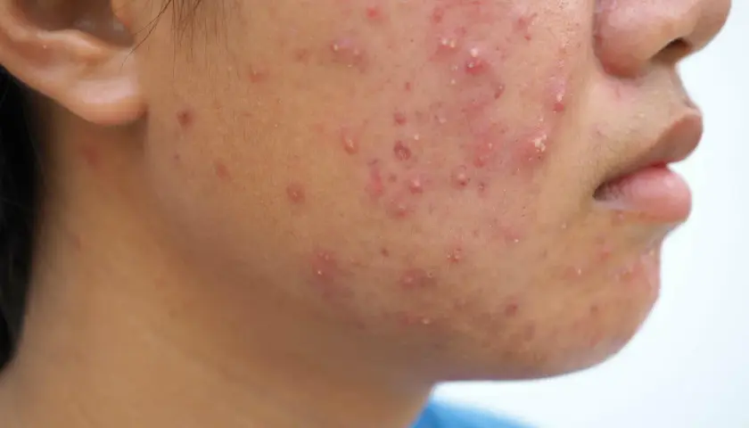 Primer plano de la mejilla de una persona con numerosos granos rojos e inflamados, algunos con pus, indicativos de acné fungico.