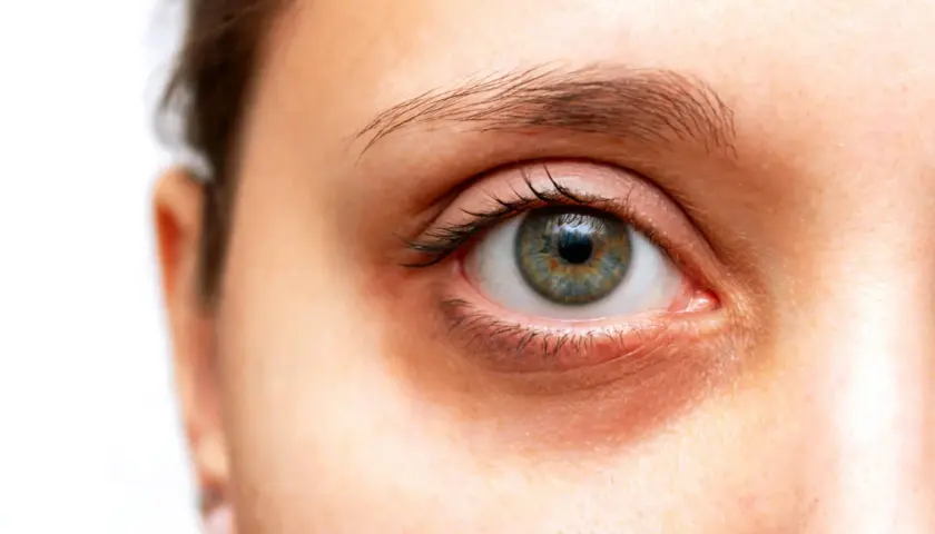 Œil humain avec des cernes visibles sous l'œil, suggérant des solutions pour comment atténuer les cernes.