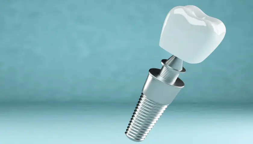 Odrzucenie implantu zęba po jakim czasie? Poznaj kluczowe czynniki