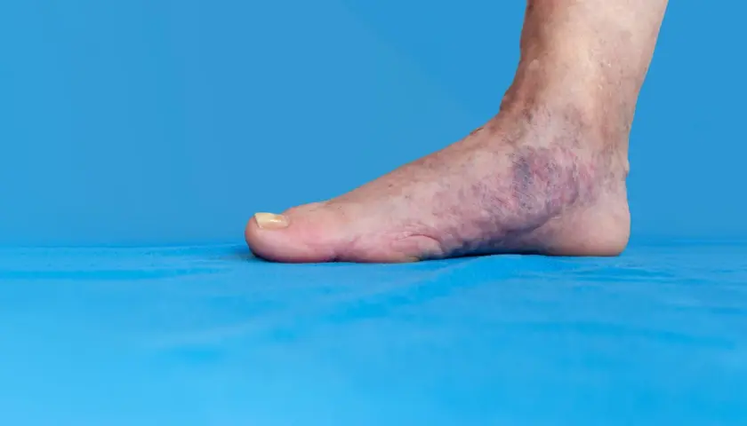 Fuß mit blauen Verfärbungen und sichtbaren Venen auf blauem Hintergrund.