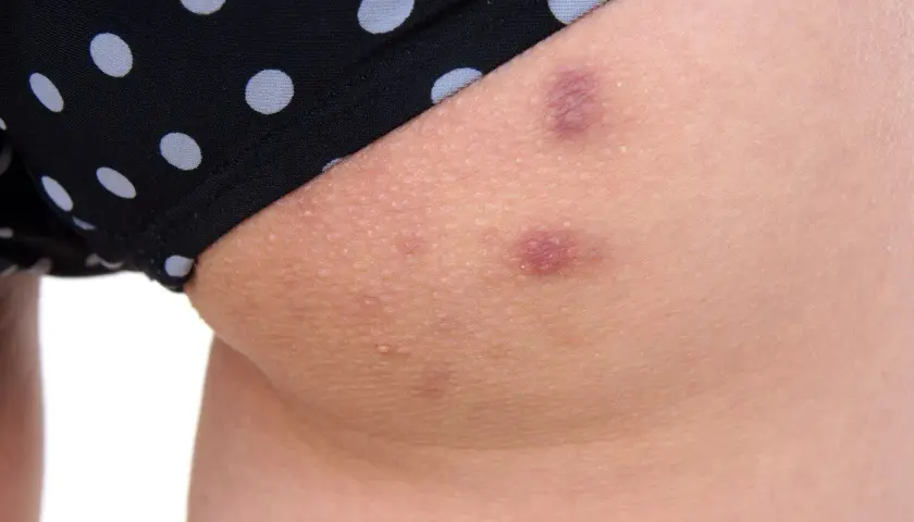 Kilka zaczerwienionych krost na pośladku, widocznych pod czarnymi majtkami w białe kropki.