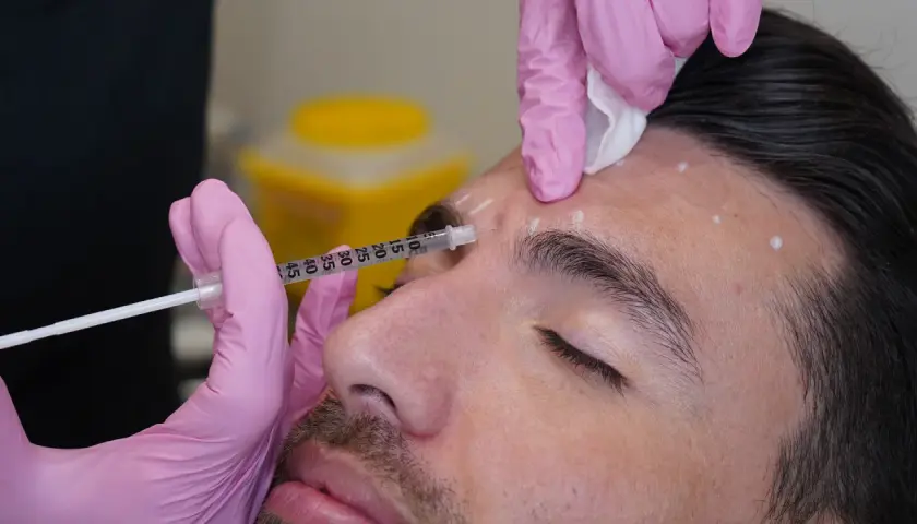 En person får medicinsk botox i pannan. Märkta punkter visar injektionsställen.