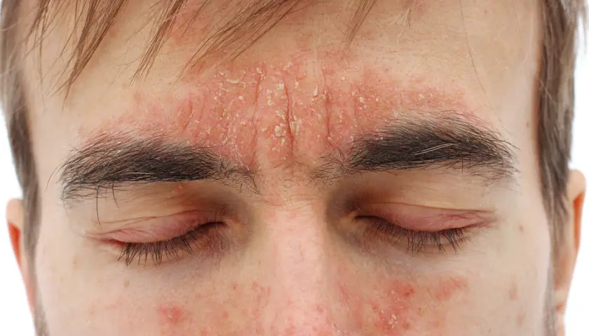 Rote, schuppige Haut im Gesicht, die auf Dermatitis hindeutet. Suche nach Dermatitis Hausmittel zur Linderung.