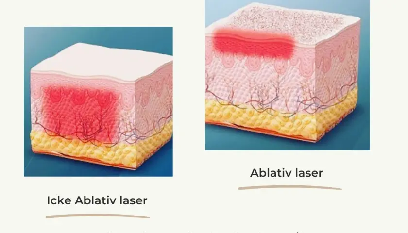 Illustrationer visar hur en co2 laser påverkar huden. Icke-ablativ laser värmer djupare, ablativ laser avlägsnar ytskiktet.