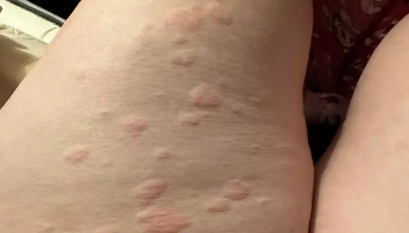 Eruzione cutanea con pomfi rossi e pruriginosi sulla pelle, possibile orticaria parainfettiva.