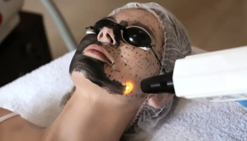 Kobieta w okularach ochronnych poddana zabiegowi peelingu węglowego laserem.