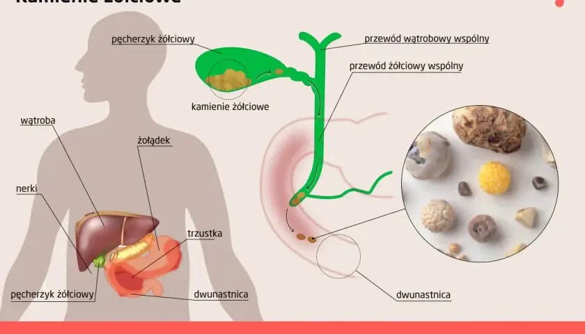 Ilustracja przedstawia anatomię człowieka z zaznaczonym pęcherzykiem żółciowym, gdzie widoczne są kamienie żółciowe. Pokazuje też drogi żółciowe i narządy trawienne.