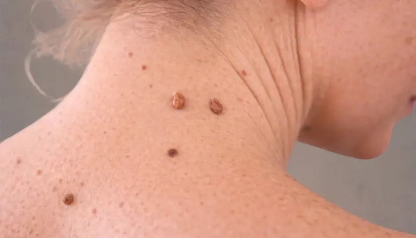 Gros grain de beauté sur le cou, peut-être un molluscum pendulum grossesse.