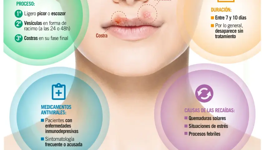 Herpes labial por estrés: el proceso incluye picor, vesículas y costras. Las recaídas pueden ser por estrés.