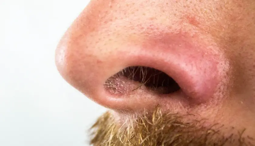 Primer plano de una nariz con poros visibles y algunas espinillas negras. Se aprecia vello facial en la parte inferior.