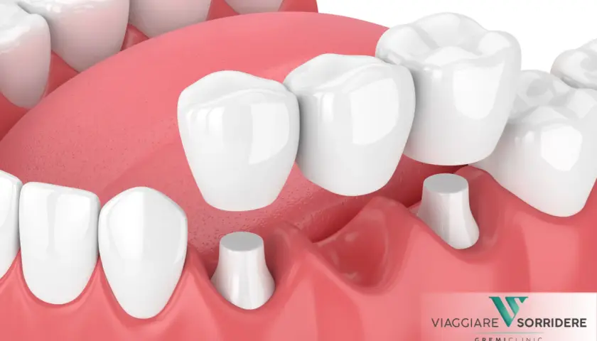 Dettaglio di una capsula devitalizzazione dente, con ponti dentali che coprono monconi preparati.