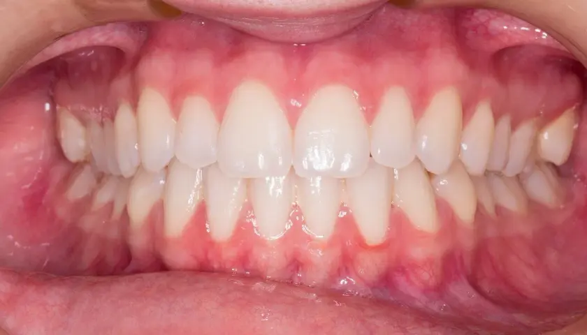 Gengive rosse e gonfie, con segni di sanguinamento gengive quando preoccuparsi. Denti bianchi e allineati.