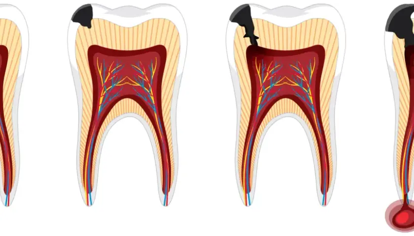 Secuencia de caries que avanza hacia la pulpa dental, mostrando la progresión de la pulpitis muela.