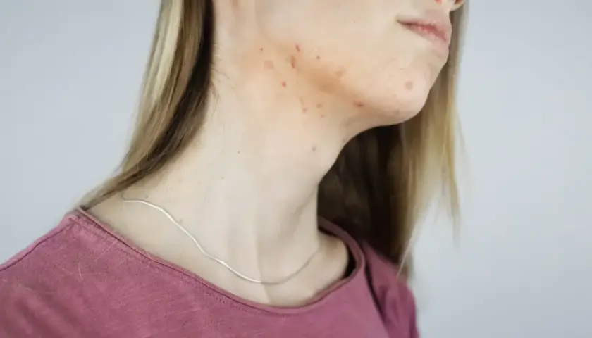Pryszcze na szyi: Przyczyny, skuteczne sposoby i kiedy do dermatologa?