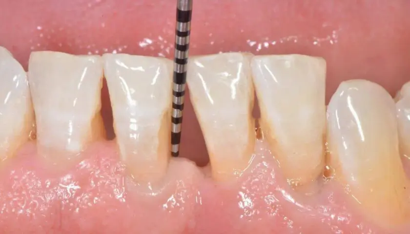 Sonda parodontale misura la profondità di un solco gengivale. Le tasche gengivali possono guarire con cure adeguate.