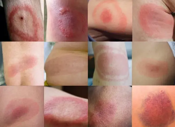 Rumień po kleszczu: Jak wygląda? Jak odróżnić od alergii?