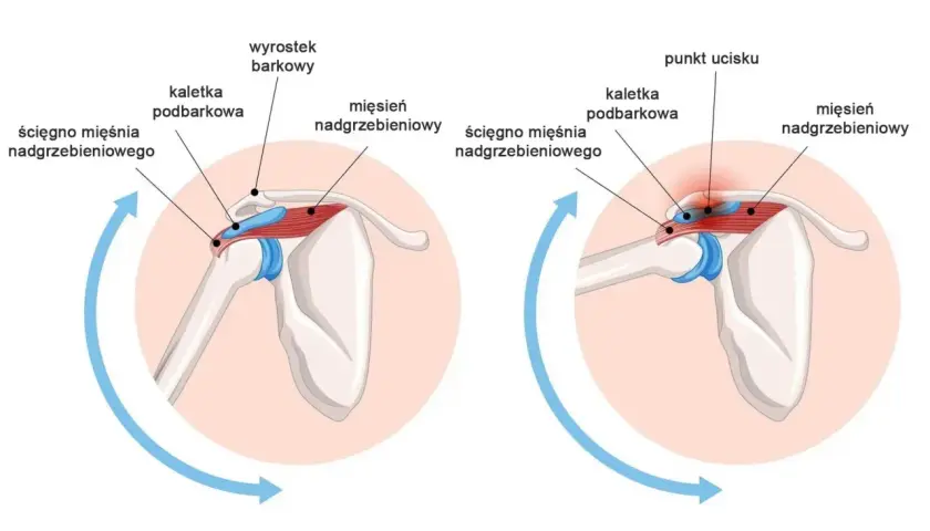 Ilustracja pokazuje ucisk na ścięgno mięśnia nadgrzebieniowego, co może wywoływać ból. Czy kości są unerwione? Nie, ale tkanki wokół nich tak.