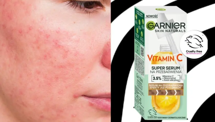 Skóra z zaczerwienieniami i niedoskonałościami. Obok opakowanie serum Garnier z witaminą C na przebarwienia, obiecujące efekty już po 6 dniach.