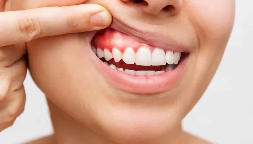 Dente con un piccolo puntino bianco sulla gengiva infiammata, evidenziato da un dito.