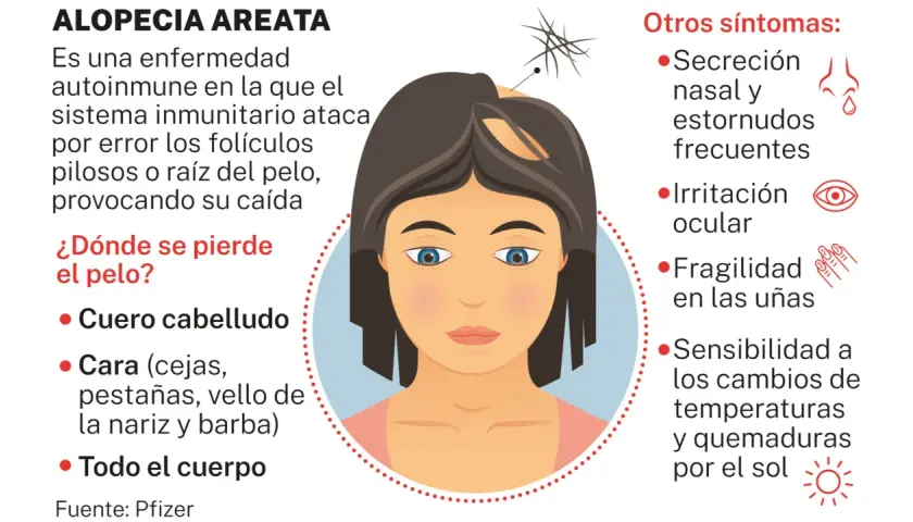 Ilustración de una mujer con alopecia areata, mostrando la pérdida de cabello en el cuero cabelludo y otros síntomas.