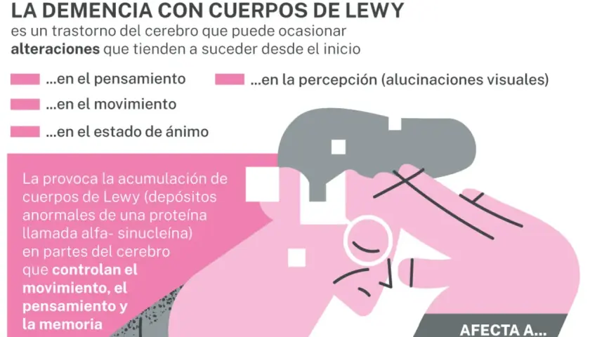 La demencia con cuerpos de Lewy afecta pensamiento, movimiento, ánimo y percepción. Se debe a depósitos de proteína alfa-sinucleína en el cerebro.