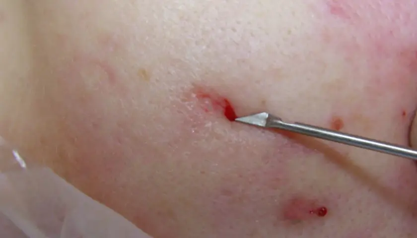 Närbild på hud där en subcision behandling utförs med ett vasst instrument som skär under ärr.