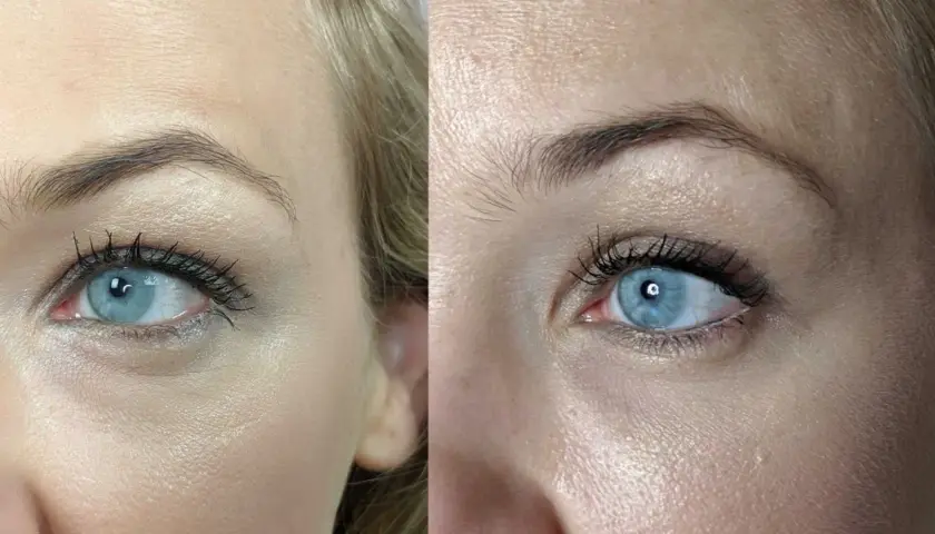 Vergleich zweier Augen: Links mit deutlichen dunklen Augenringen, rechts mit aufgehellter Hautpartie unter dem Auge.