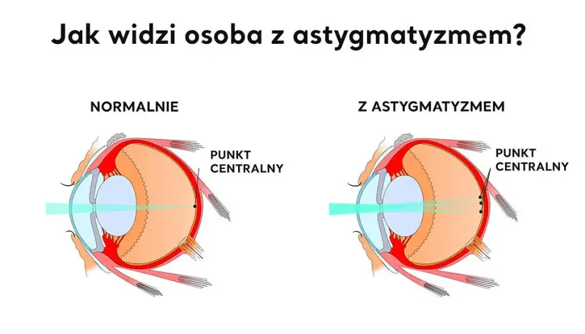 Jakie są wady wzroku? Poznaj objawy i skuteczne leczenie