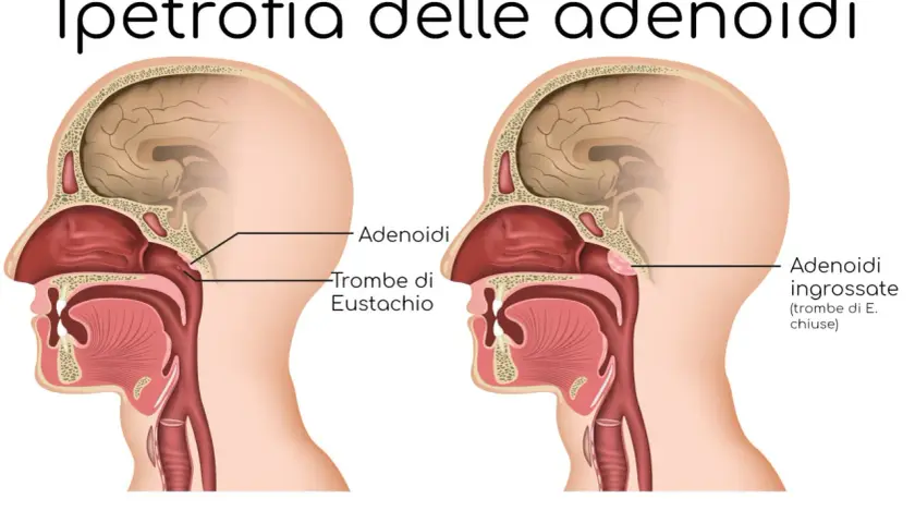 Confronto tra adenoidi normali e ingrossate che ostruiscono le trombe di Eustachio.