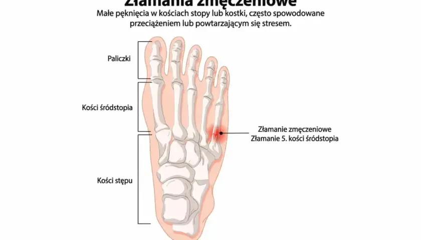 Złamanie zmęczeniowe 5. kości śródstopia, widoczne jako czerwona plama na szkielecie stopy.