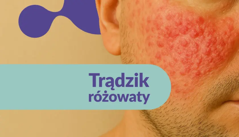 Trądzik różowaty na twarzy. Szukasz informacji o rozex krem opinie?