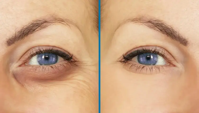 Ojos con ojeras hundidas y arrugas antes y después de un tratamiento.