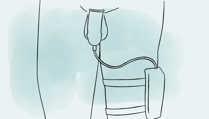 Illustration zeigt, wie man ein Urinalkondom anlegt. Ein Schlauch verbindet das Kondom mit einem Auffangbeutel am Bein.