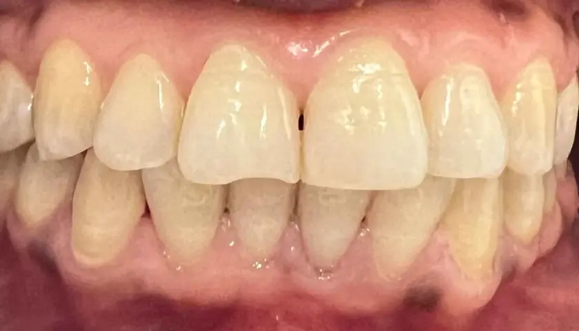 Primer plano de dientes y encías, mostrando algunas manchas oscuras en las encías.
