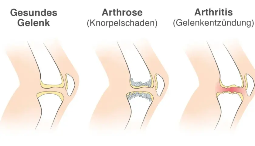 Vergleich von Gelenken: gesund, Arthrose (Knorpelschaden) und Arthritis (Gelenkentzündung). Arthritis zeigt eine Entzündung im Gelenk.
