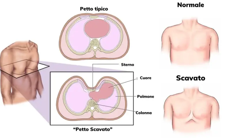 Confronto tra petto tipico e petto escavato nei bambini. Illustrazione anatomica mostra la forma del torace e la posizione degli organi interni.