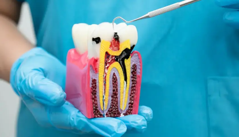 Model zęba z widocznym wypełnieniem kanałów korzeniowych gutaperką. Dentysta pokazuje, jak wygląda prawidłowe leczenie kanałowe.