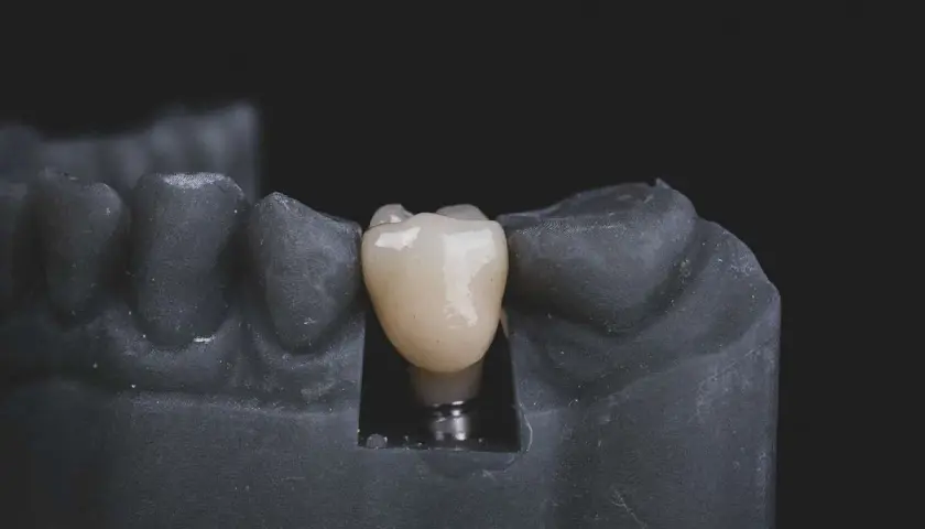Modello di arcata inferiore con impianto dentale e corona in ceramica.